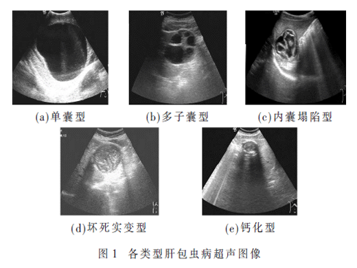 基于YOLOv5l的囊型肝包蟲病病灶檢測研究