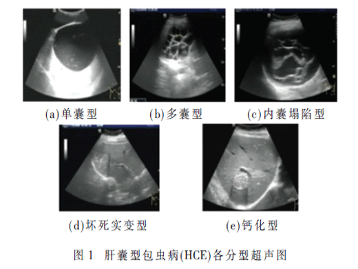 基于Swin Transformer的肝囊型包蟲病超聲圖分類研究